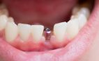 What To Expect If You Need a Dental Bone Graft