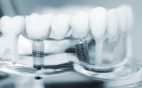 dental implants Cleveland TN
