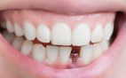 cleveland-tn-oral-and-maxillofacial-surgeons-dentures-vs-dental-implants