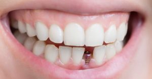 cleveland-tn-oral-and-maxillofacial-surgeons-dentures-vs-dental-implants