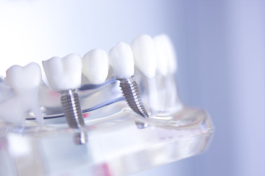Dental implants offer an ideal, long-term solution to tooth loss that helps to prevent other issues down the road, such as bone loss.