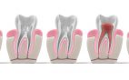 Ocoee Oral Surgery in Cleveland TN offers apicoectomy procedures for patients in which root canals have not been a successful course of treatment.