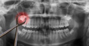 You may need to schedule your wisdom teeth removal to address issues like pain, crowding, and to prevent possible infection with impacted wisdom teeth.