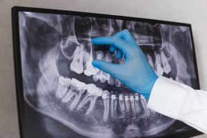 How to Choose the Right Chattanooga Oral Surgeon